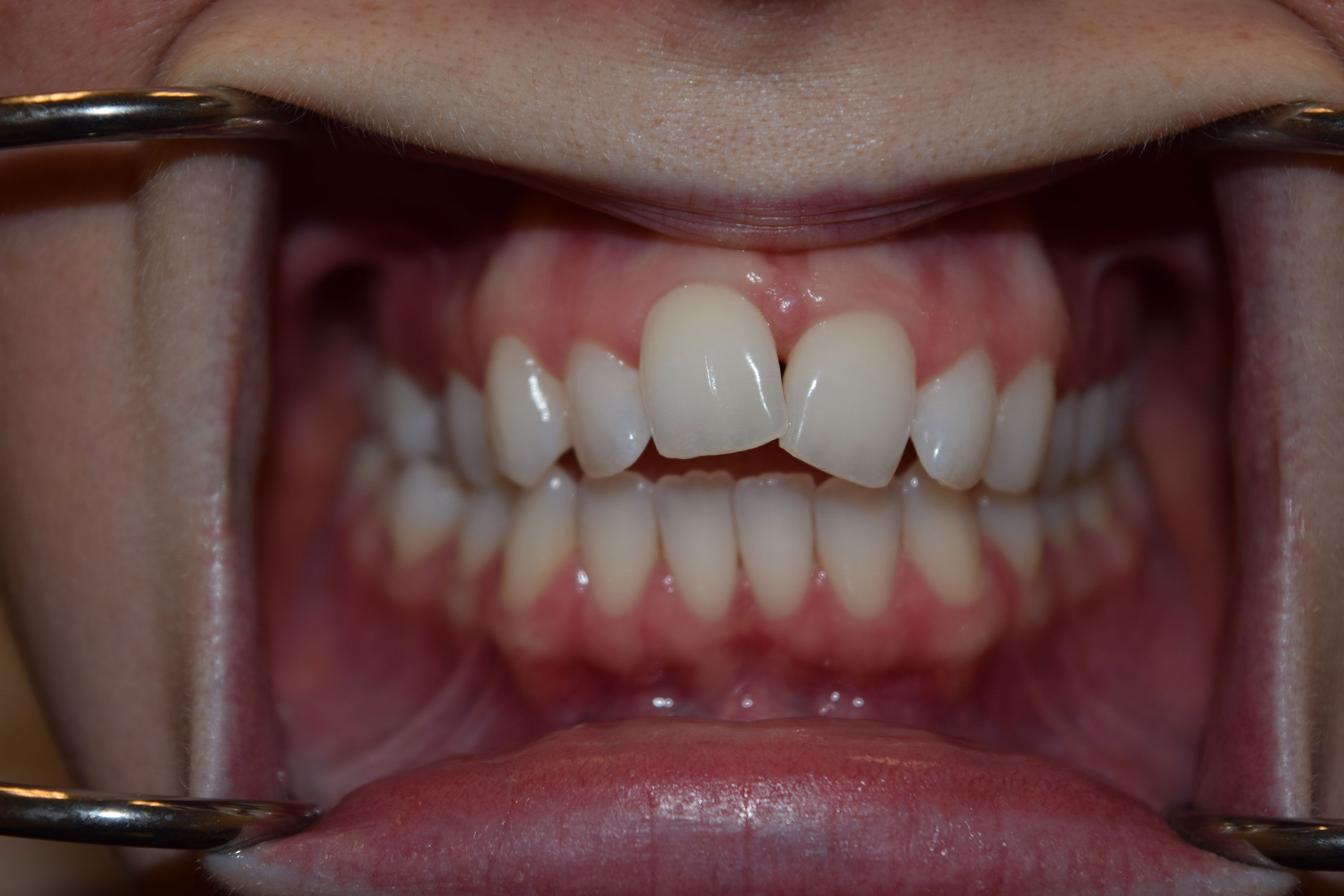 Before Invisalign treatment