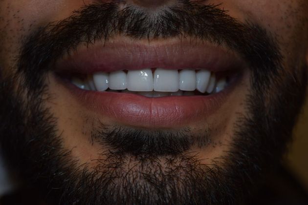 after veneers